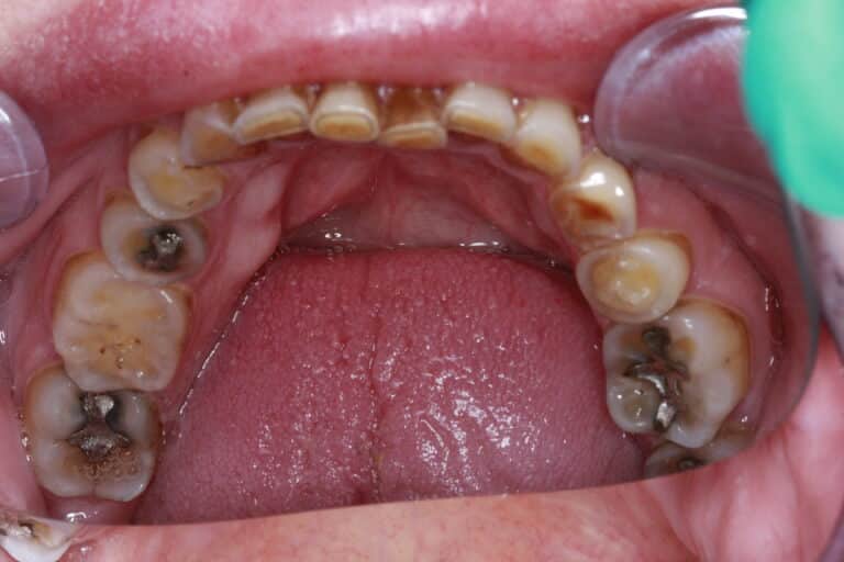 After Image: Severe Wear - front