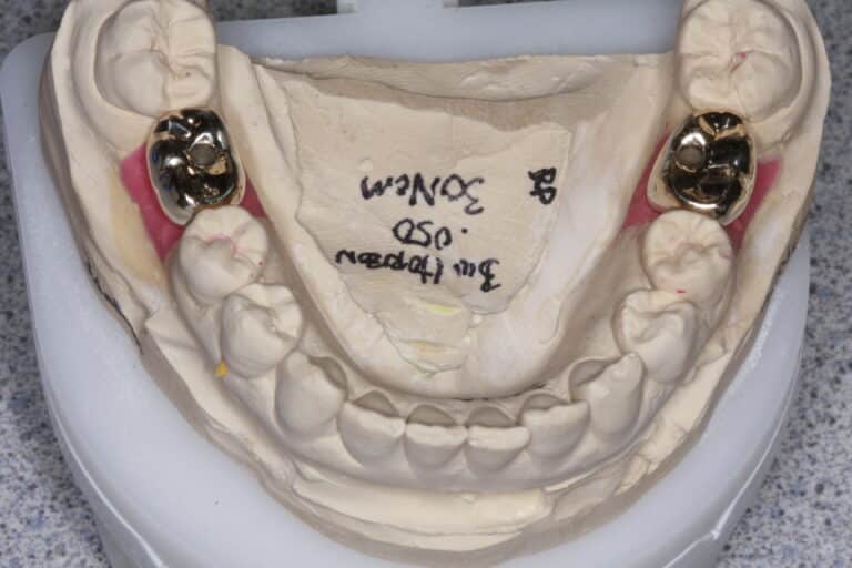 Before Image: Gold Crowns - front
