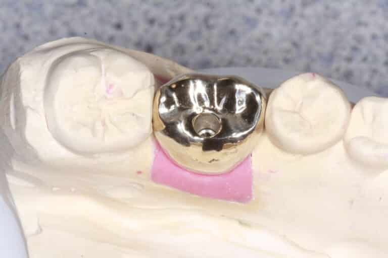 After Image: Gold Crowns - front