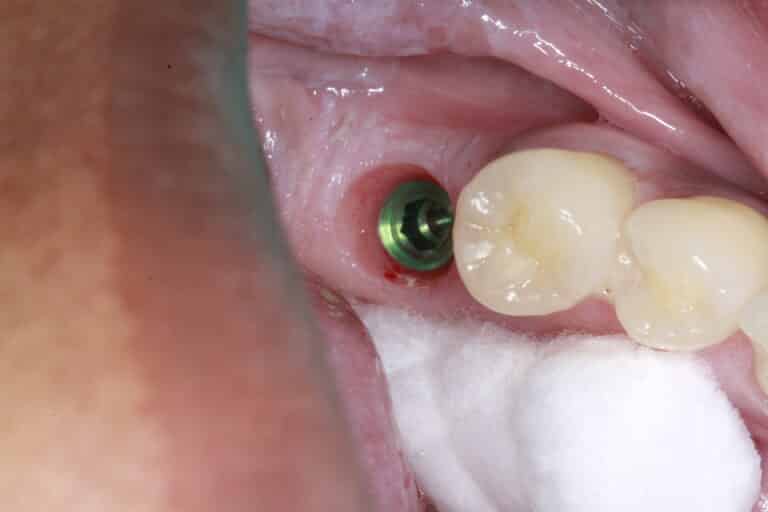 After Image: Gold Crowns - front