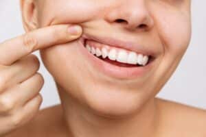Woman showing her receding gums in Milwaukee, WI
