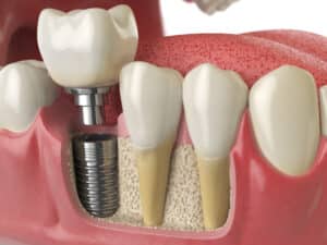 3D illustration of a dental implant