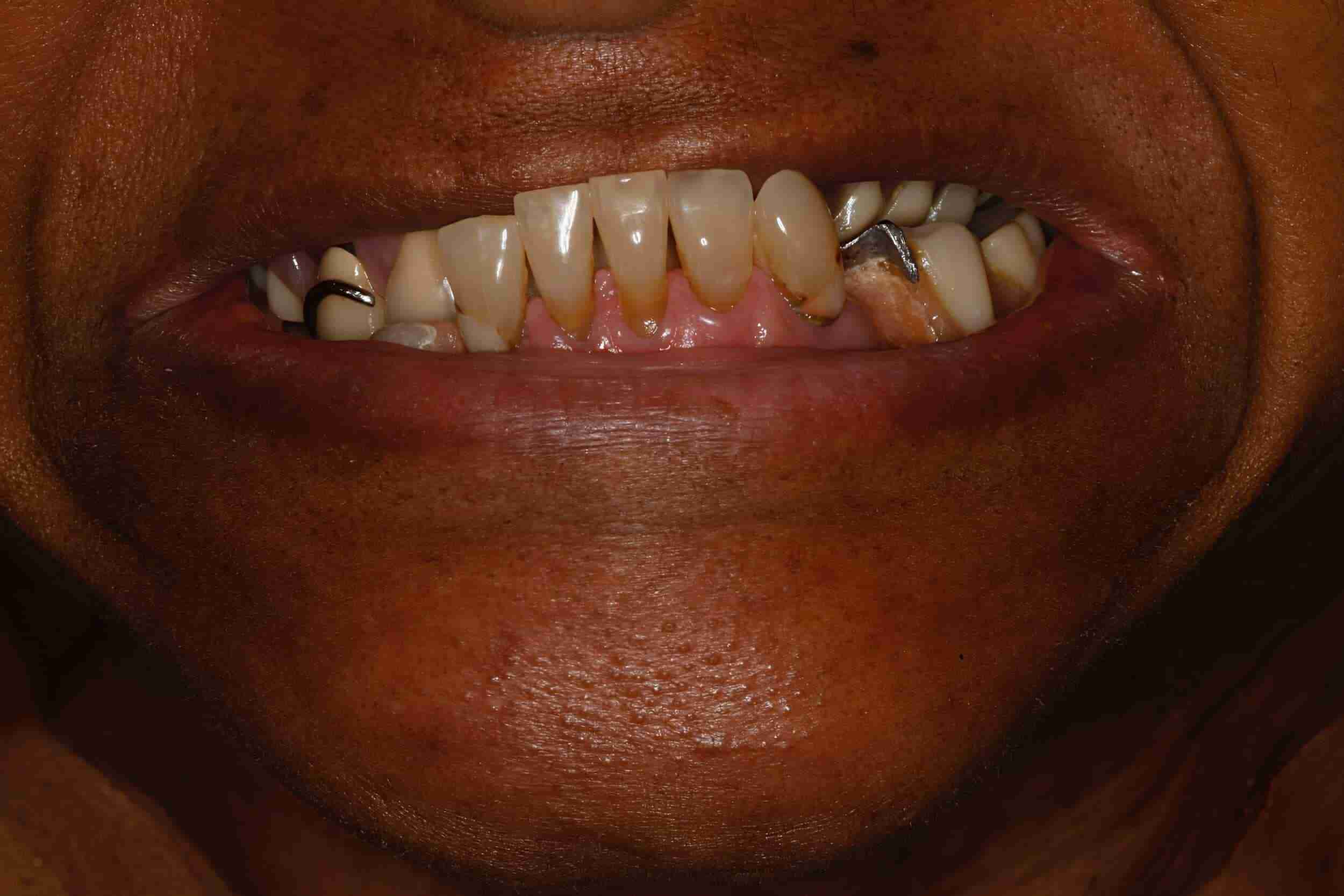 Before Dental Patient Photos