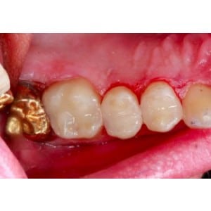 Dental Bonding with Composite Resin