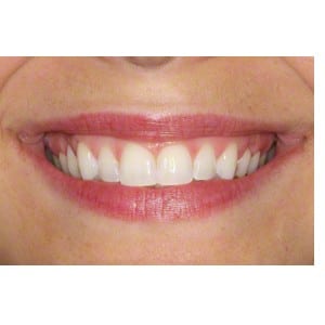 Composite Bonding Of Chipped Teeth After