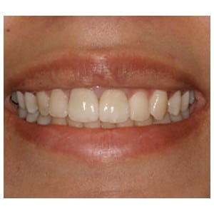 Amal Anterior Crowns Cosmetic