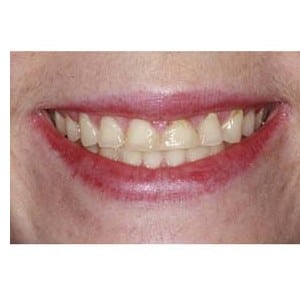 Rehabilitation Of Bulimia With Orthodontics & Crowns