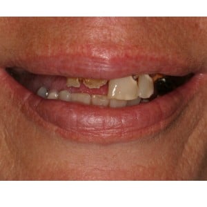 Dental Implants Patient