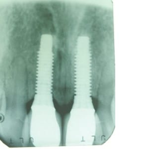 Dental Implants Patient