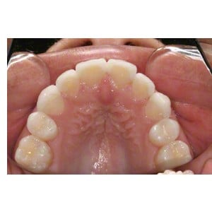 Dental Veneers Patient