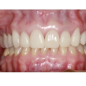 Dental Crowns Patient